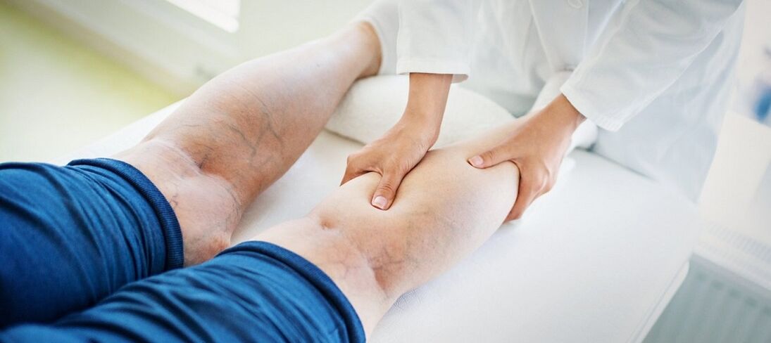 varices en las piernas y su tratamiento