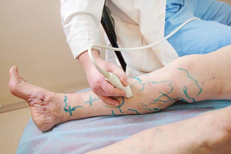 Preparación para miniflebectomía marcación en las perforaciones de la parte inferior de la pierna, realización de ecografía